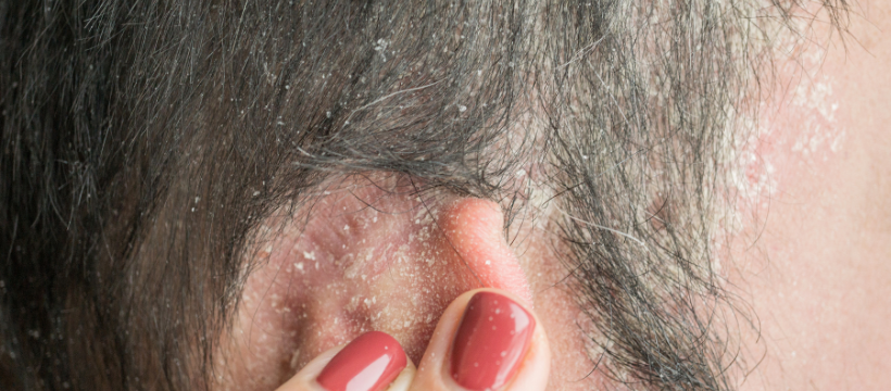 How to Cure Scalp Psoriasis Permanently